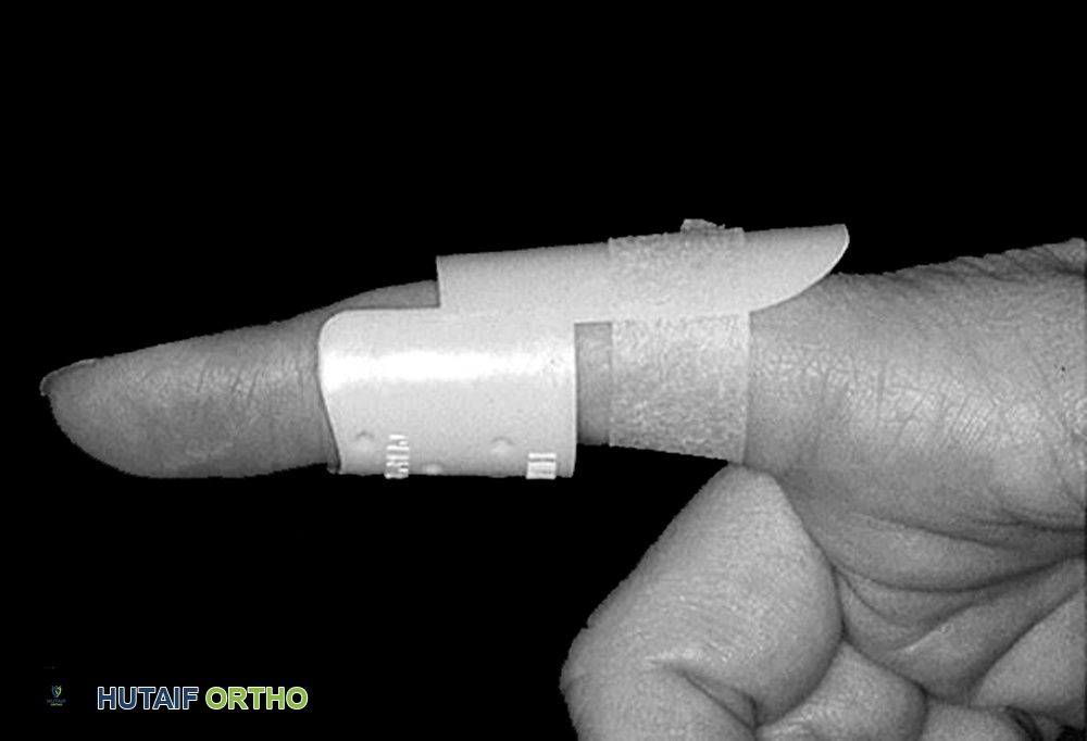 A commercial splint used in treating boutonnière deformity. Splinting helps keep the ends of the tendon from separating during healing.