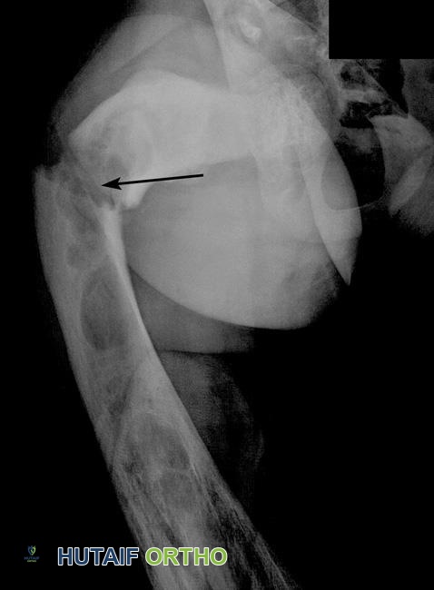 خلل التنسج الليفي العظمي: دليل شامل للمرضى مع الأستاذ الدكتور محمد هطيف