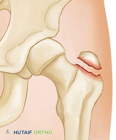 صورة طبية: كسور الورك: دليل الأستاذ الدكتور محمد هطيف الشامل للتشخيص والعلاج في صنعاء