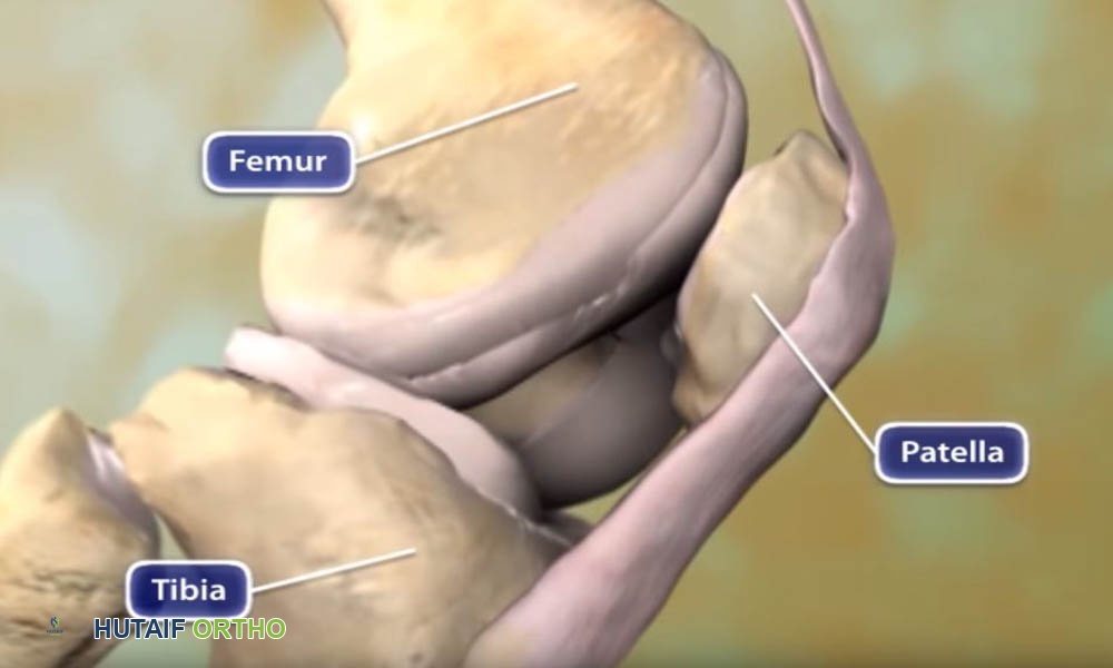 رسوم متحركة لخشونة مفصل الركبة