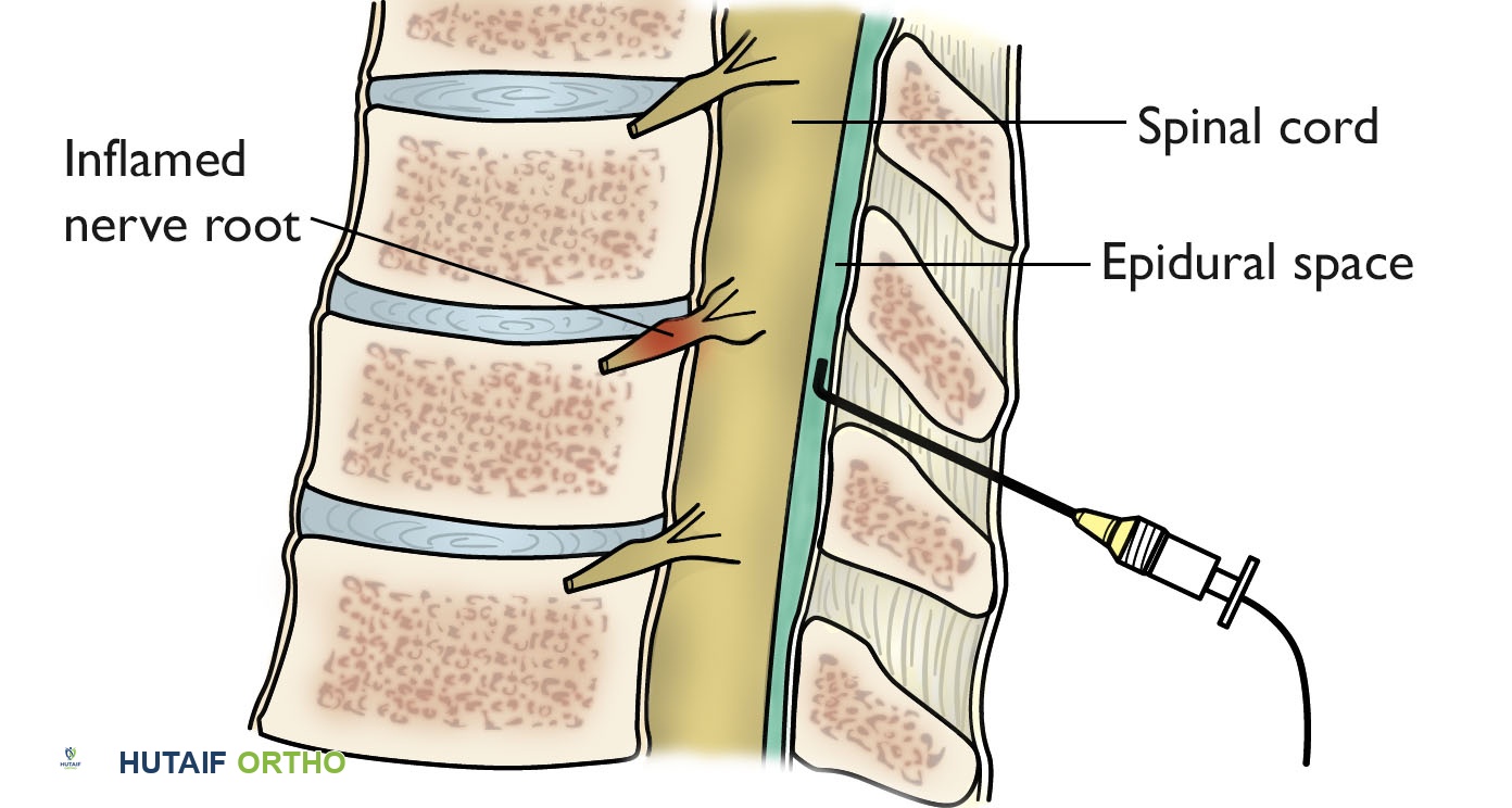 صورة توضيحية لـ عرق النسا دليل شامل للأسباب الأعراض والعلاج مع الأستاذ الدكتور محمد هطيف