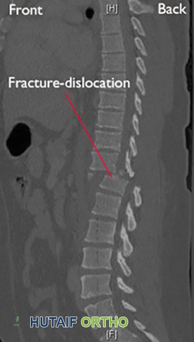 صورة مقطعية لخلع كسر في العمود الفقري الصدري