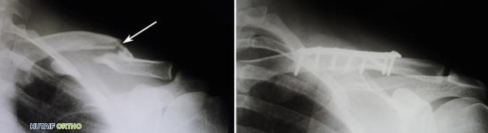 صورة توضيحية لـ كسر الترقوة (عظم الترقوة المكسور): دليل شامل للمرضى مع الأستاذ الدكتور محمد هطيف