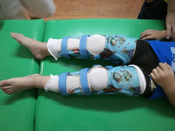 Pediatric Knee Ankle Foot Orthosis (KAFO)