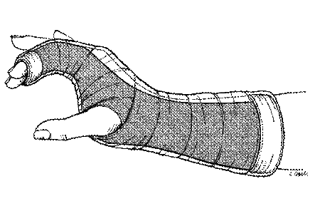 Radial Gutter Splint