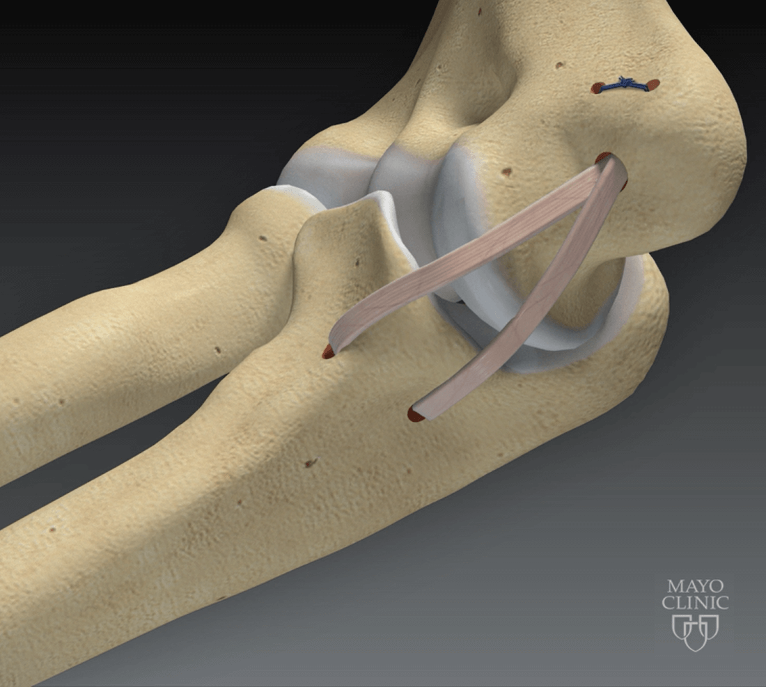 Ulnar Collateral Ligament (UCL) Elbow Brace