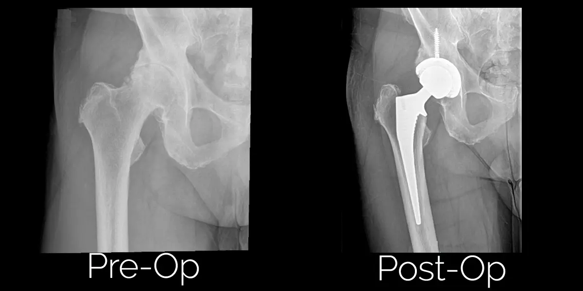 صورة أشعة قبل وبعد زراعة مفصل الورك للسيدة أسيدة، تُظهر المفصل الصناعي في مكانه السليم