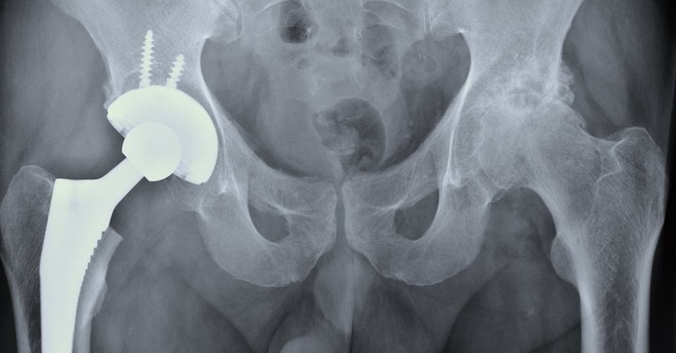 مفصل ورك صناعي من Stryker