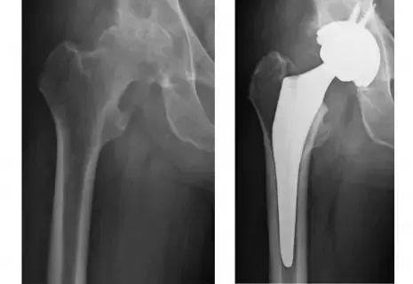 سعر مفصل الورك الصناعي في اليمن 2026: دليل التكلفة الشامل