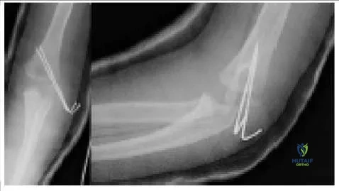 Orthopedic Prometric Exam Chapter 3 Image