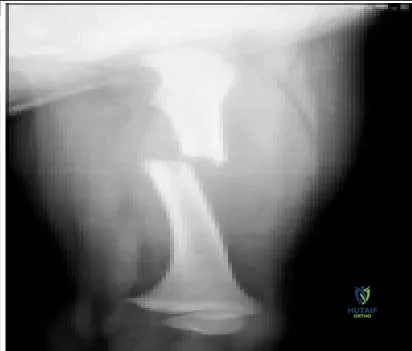 Orthopedic Prometric MCQs - Chapter 3 Part 14