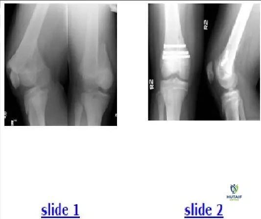 Orthopedic Prometric MCQs - Chapter 3 Part 16
