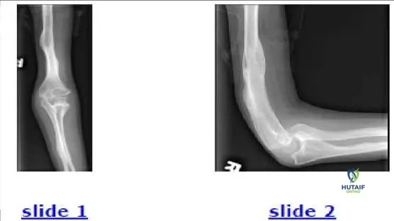 Orthopedic Prometric MCQs - Chapter 3 Part 18