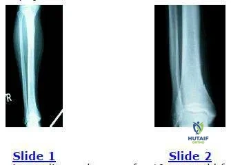 Orthopedic Prometric MCQs - Chapter 3 Part 46