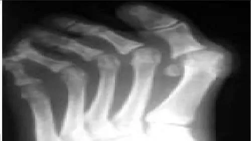 Orthopedic Prometric Exam Question