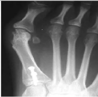 Orthopedic Prometric Exam Question