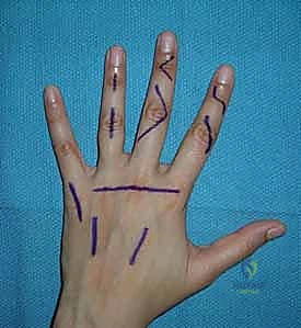 Mastering Hand & Forearm Surgical Approaches: An Intraoperative Guide