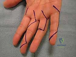 حالة متقدمة من التهاب المفاصل وتأثيرها على اليد