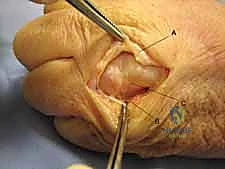 صورة من داخل غرفة العمليات توضح الدقة الجراحية