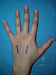 صورة شعاعية لكسور وتثبيت العظام