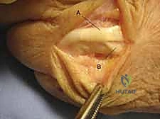 استخدام المنظار الجراحي في عمليات الرسغ