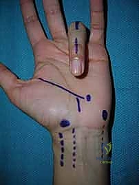 صورة توضيحية لـ جراحة اليد والرسغ والساعد دليل شامل للمرضى مع الأستاذ الدكتور محمد هطيف