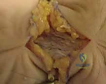 صورة توضيحية لـ جراحة اليد والرسغ والساعد دليل شامل للمرضى مع الأستاذ الدكتور محمد هطيف