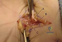 جراحة اليد والرسغ والساعد دليل شامل للمرضى مع الأستاذ الدكتور محمد هطيف