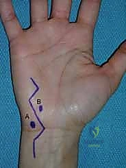 صورة توضيحية لـ جراحة اليد والرسغ والساعد دليل شامل للمرضى مع الأستاذ الدكتور محمد هطيف