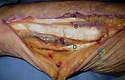 مراحل تعافي اليد بعد إصابة عمل معقدة