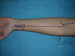 صورة توضيحية لـ جراحة اليد والرسغ والساعد دليل شامل للمرضى مع الأستاذ الدكتور محمد هطيف