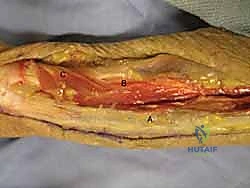 صورة توضيحية لـ جراحة اليد والرسغ والساعد دليل شامل للمرضى مع الأستاذ الدكتور محمد هطيف