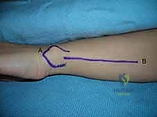 إغلاق الجرح والنتائج التجميلية بعد الجراحة