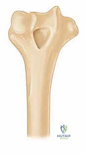 مقارنة بين العلاج التحفظي والجراحي