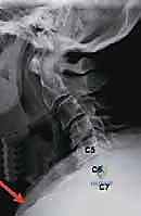 الضغط على الأعصاب في الرقبة