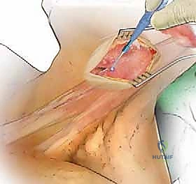 العلاج التحفظي مقابل الجراحي