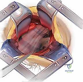تقنية الميكروسكوب الجراحي