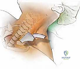 نجاح جراحة العمود الفقري في اليمن