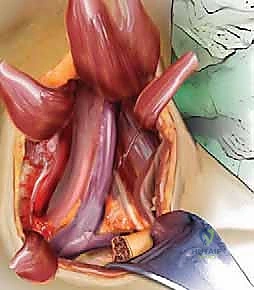 استخدام الميكروسكوب في جراحة الرقبة