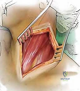 صعوبة البلع المؤقتة بعد العملية