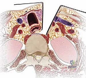 التثبيت بالشريحة والمسامير في الرقبة