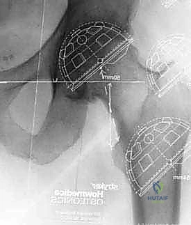 صورة توضيحية لـ استبدال مفصل الورك الكلي بالإسمنت: دليل شامل لمرضى الدكتور محمد هطيف في صنعاء
