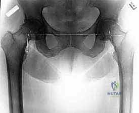 صورة توضيحية لـ استبدال مفصل الورك الكلي بالإسمنت: دليل شامل لمرضى الدكتور محمد هطيف في صنعاء