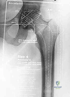 استبدال مفصل الورك الكلي بالإسمنت: دليل شامل لمرضى الدكتور محمد هطيف في صنعاء