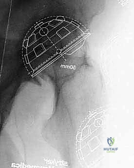 تشريح مفصل الورك وتآكل الغضاريف