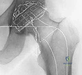 التحضير لعملية استبدال مفصل الورك