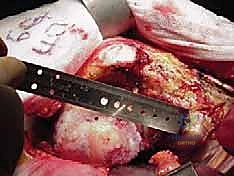 صورة توضيحية لـ استبدال مفصل الورك الكلي بالإسمنت: دليل شامل لمرضى الدكتور محمد هطيف في صنعاء