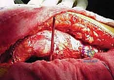 Illustration of cemented total hip - Dr. Mohammed Hutaif