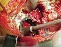 صورة توضيحية لـ استبدال مفصل الورك الكلي بالإسمنت: دليل شامل لمرضى الدكتور محمد هطيف في صنعاء