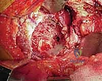 صورة توضيحية لـ استبدال مفصل الورك الكلي بالإسمنت: دليل شامل لمرضى الدكتور محمد هطيف في صنعاء